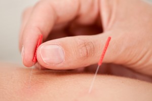 Acupuncture from Dr Maegan Knutson Naturopath Everett Mukilteo Seattle